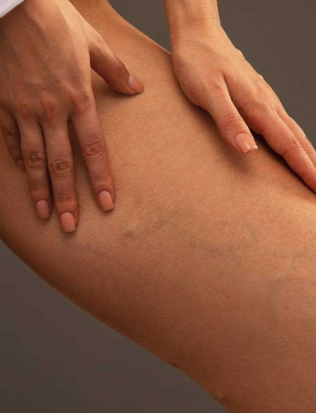 Beautiful,Slender,Woman,Shows,Varicose,Veins,On,The,Legs.,Treatment