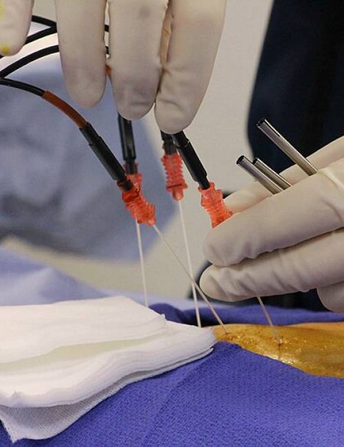 Radiofrequency Neurotomy (Endoscopic Method)