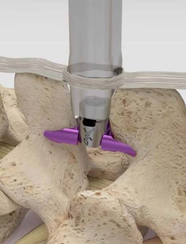 Superion Interspinous Spacer (Vertiflex)