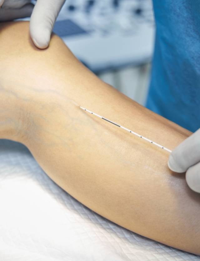 Process,Of,Laser,Treatment,Of,Vein,Disorders